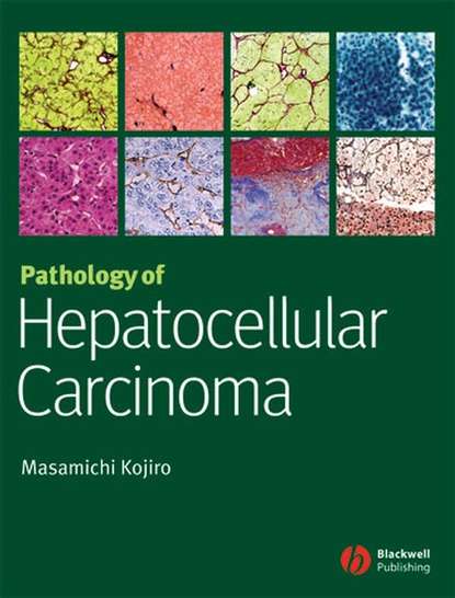 Pathology of Hepatocellular Carcinoma - Группа авторов