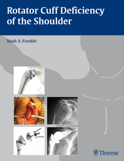 Группа авторов - Rotator Cuff Deficiency of the Shoulder