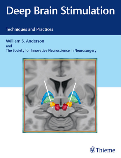 William S. Anderson - Deep Brain Stimulation