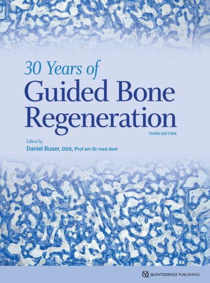 

30 Years of Guided Bone Regeneration