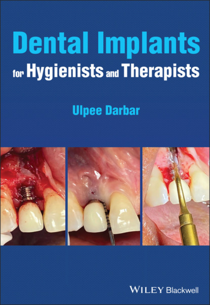 Dental Implants for Hygienists and Therapists - Ulpee R. Darbar