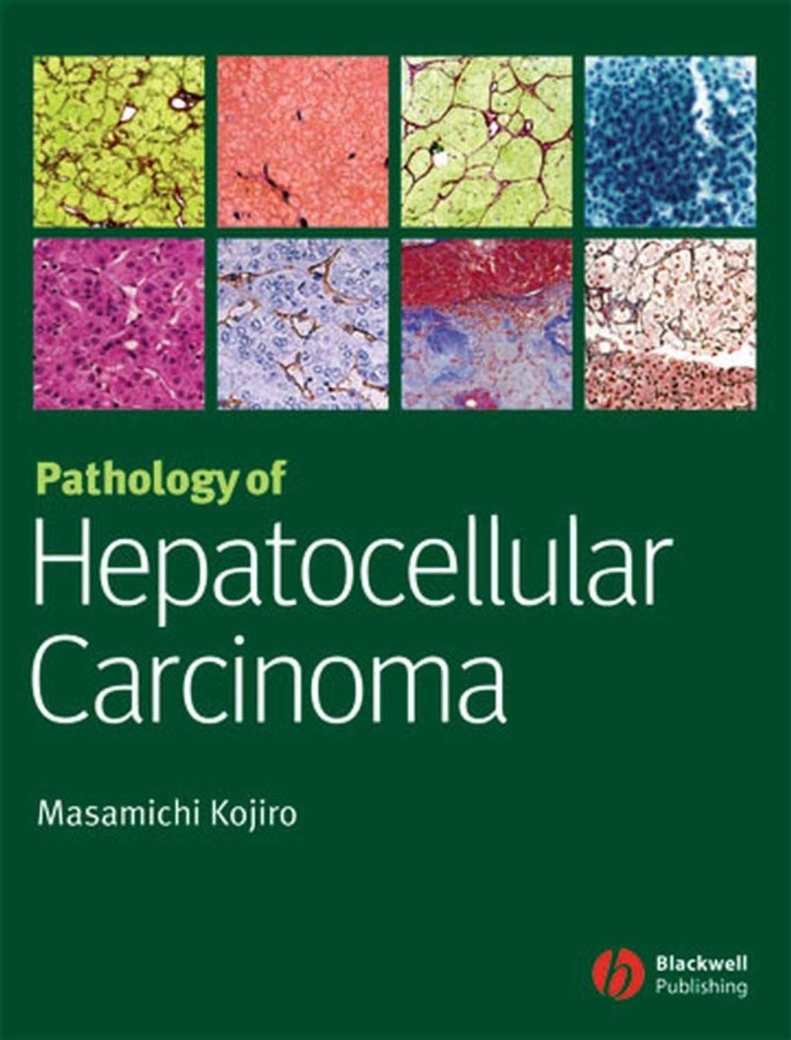 pathology-of-hepatocellular-carcinoma-pdf