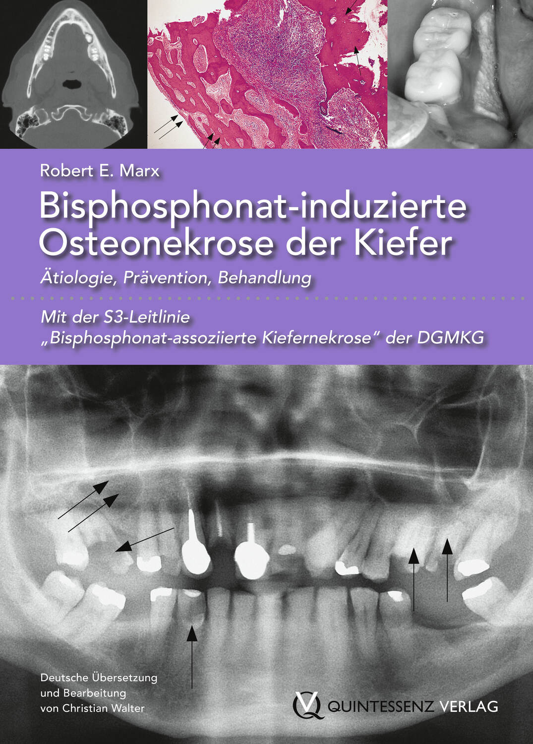 Bisphosphonat-induzierte Osteonekrose der Kiefer / Ätiologie, Prävention, Behandlung – eBook ...
